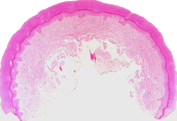 Figura 2 - Imagen panormica. Se aprecia discreta hiperpigmentacin focal en la capa basal. H&E 20 x